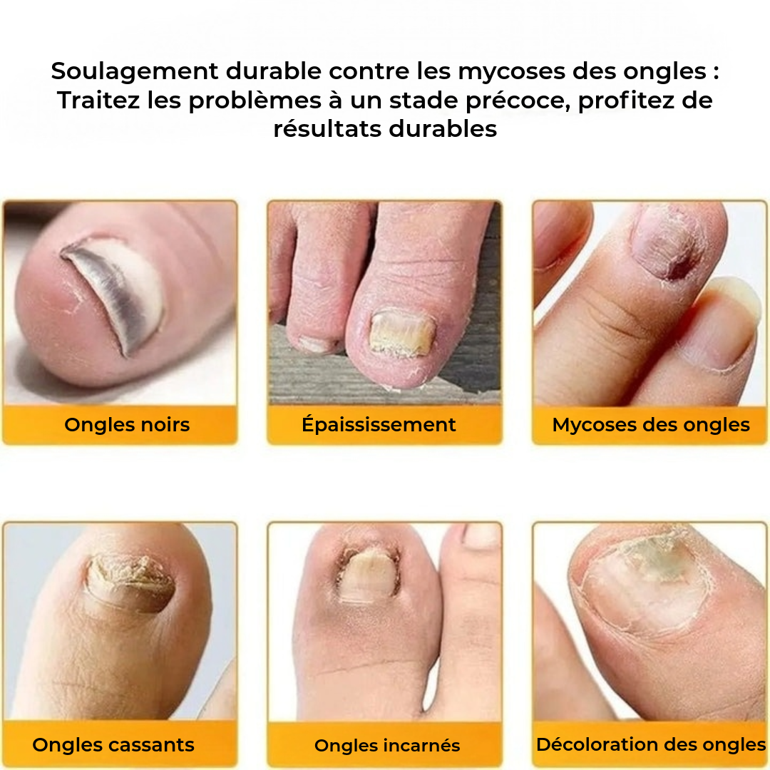 FungalPatch - Patch Antibactérien Antifongique et Soin des Ongles Pack