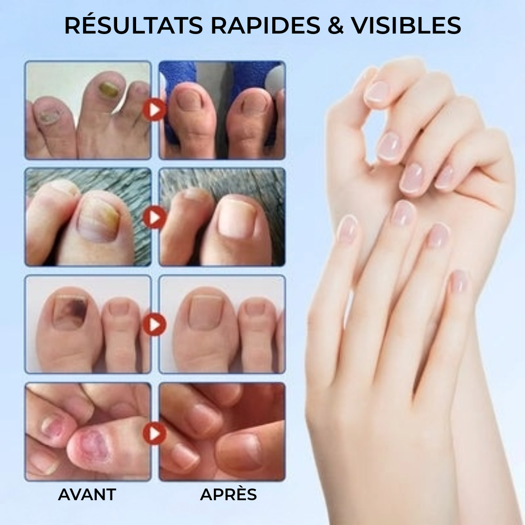 FungalPatch - Patch Antibactérien Antifongique et Soin des Ongles Pack