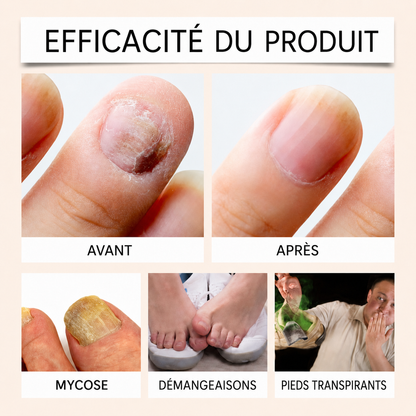Spray au venin d’abeille contre les mycoses des ongles